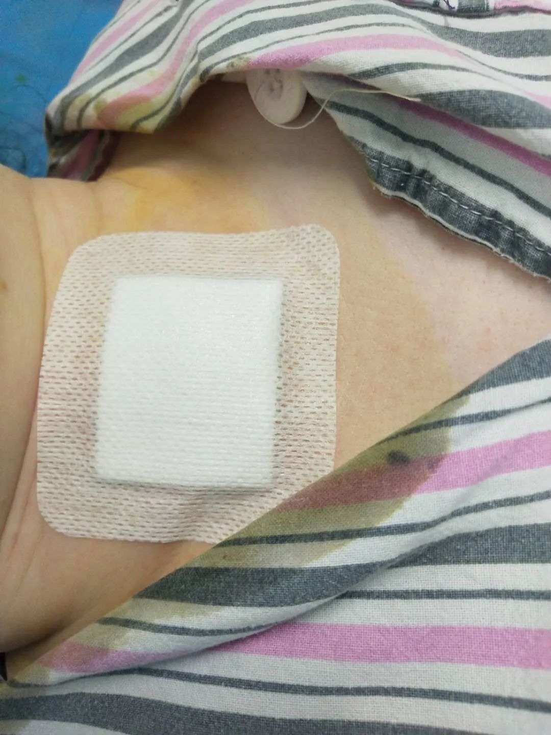 甲状腺结节心慌发热失眠,甲状腺手术成功案例