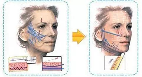 线雕隆鼻取出来要多少钱,线雕隆鼻8000