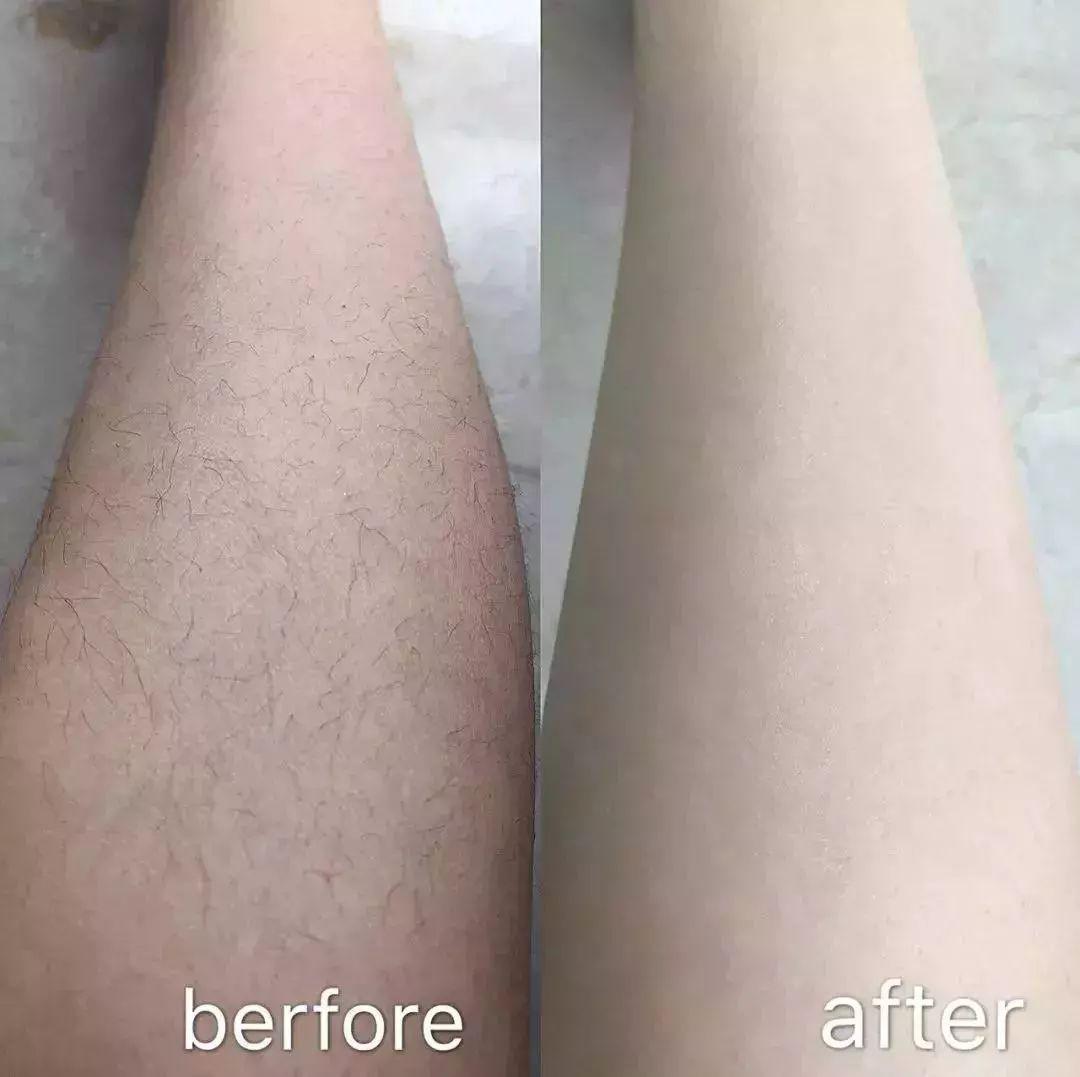 美白脱毛永久有效的产品,大家有什么好的永久脱毛推荐