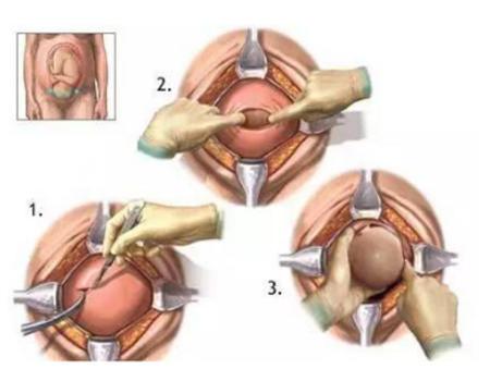 剖腹产让人感动的话,剖腹产出来感人时刻