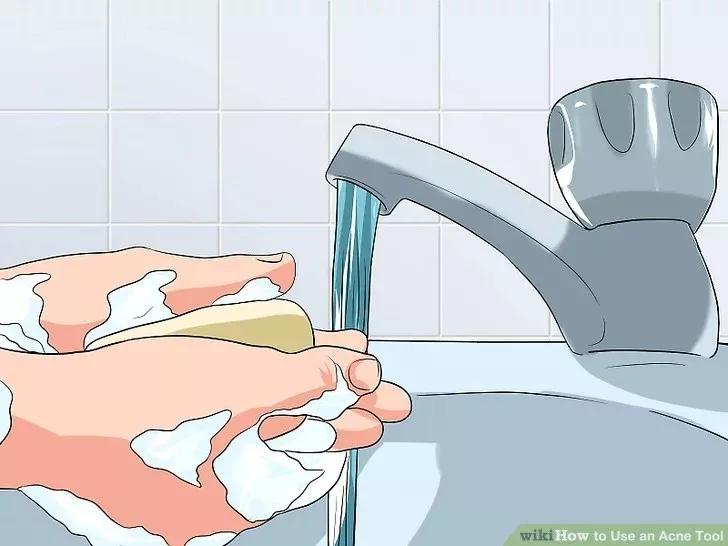 针清祛痘一般多少钱一次,针清祛痘后可以涂甲硝唑吗