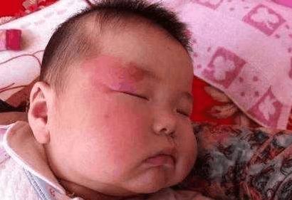 如何避免宝宝身上有胎记,宝宝有了胎记妈妈怎么办
