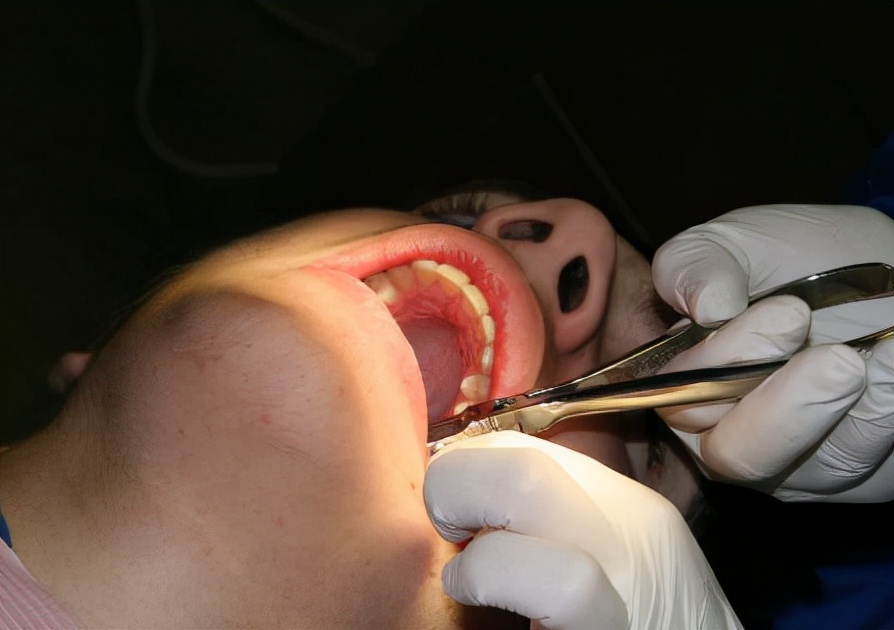 拔完智齿脸肿的像包子怎么护理,拔了智齿缝针拆完线怎么护理