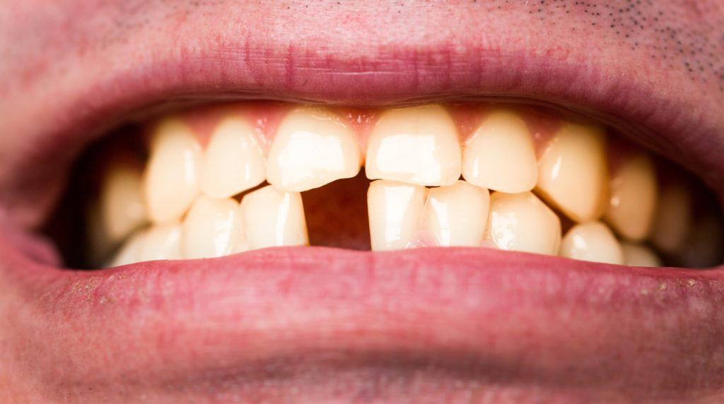 牙齿缺失多个的最佳修复方法,多颗牙齿缺失怎么修复多少钱