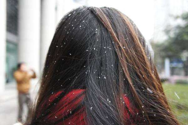 头皮屑很多怎么去头屑效果最明显,头皮屑多怎么办9个方法告别头屑