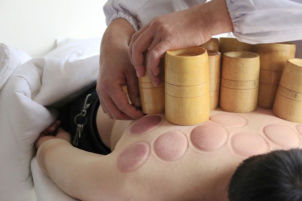 拔罐后皮肤上紫黑色印记,是什么?