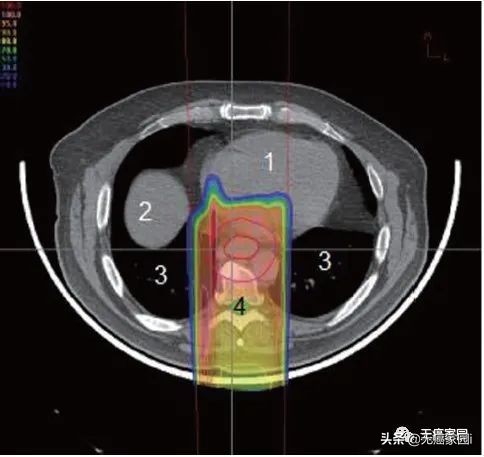 质子治疗消化道肿瘤,质子重离子治疗肠胃瘤