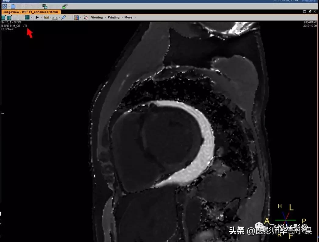 飞利浦磁共振快速扫描方案指南,飞利浦1.5t磁共振各部位扫描技术