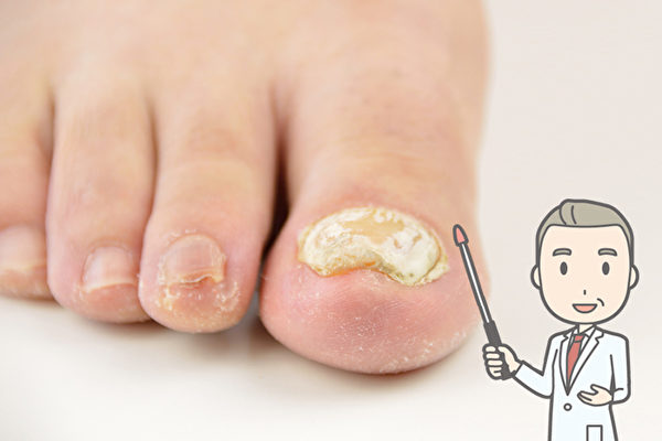 得了灰指甲怎么防止传染其他指甲,指甲变厚会传染是灰指甲吗