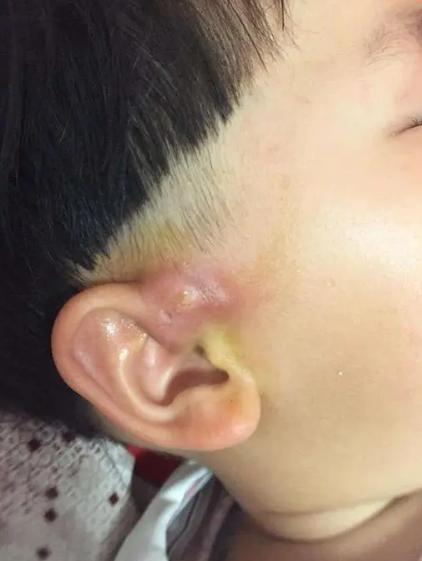 宝宝耳朵长了两个肉球想手术,小孩耳朵长肉疙瘩多大可以手术