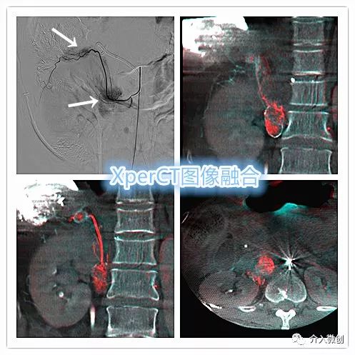 肝癌腹膜后淋巴结转移是怎么回事,肝癌腹腔淋巴结转移瘤意味着什么