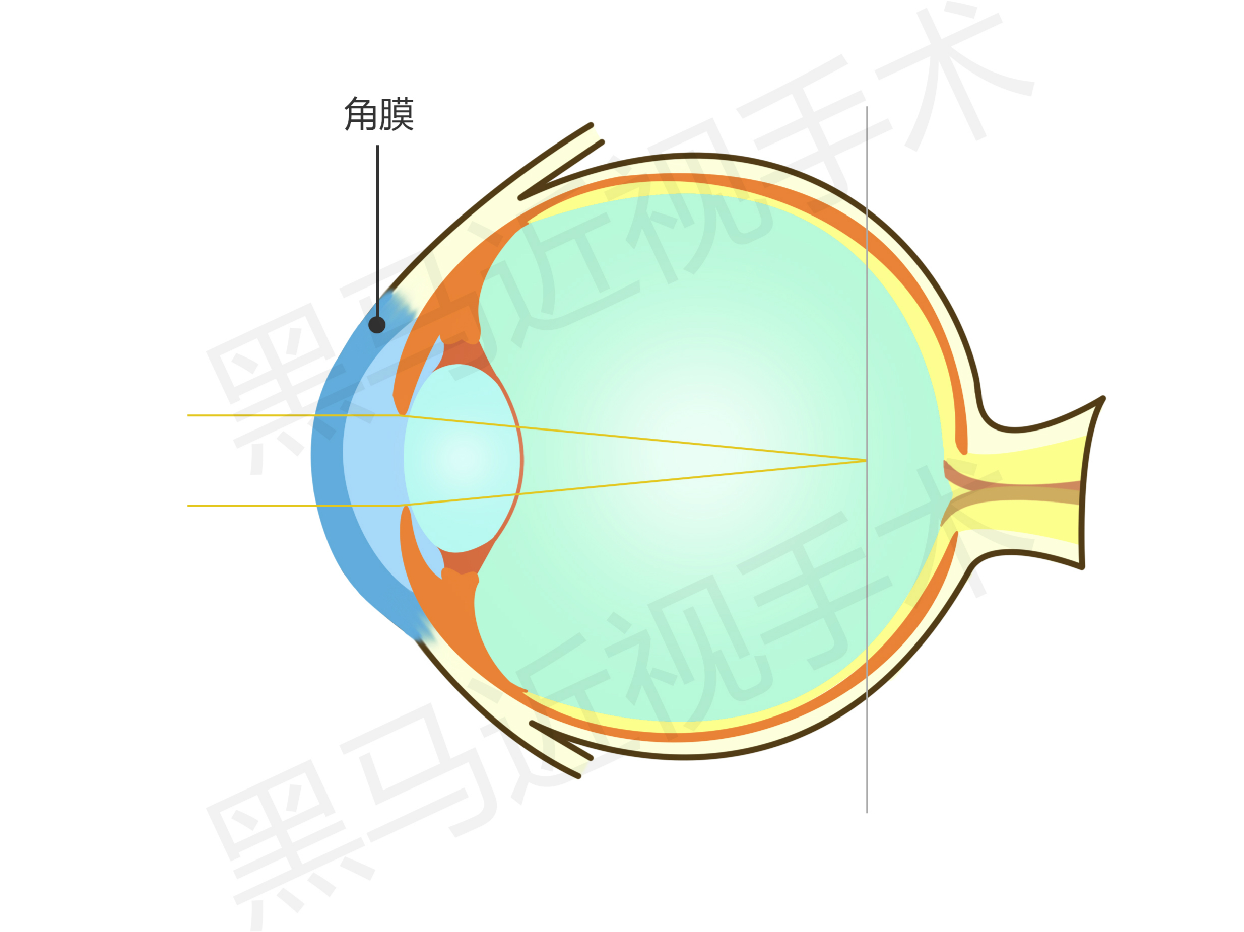 高度近视眼1000度视频,高度近视1000度会瞎吗