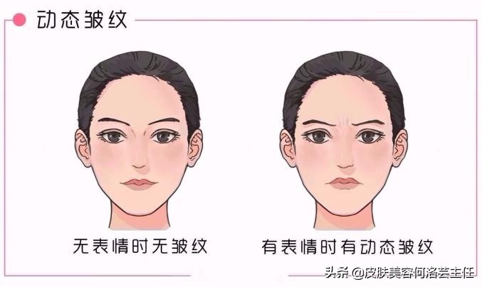 脸上出现皱纹，我老了？5个皱纹产生的原因，别再视而不见