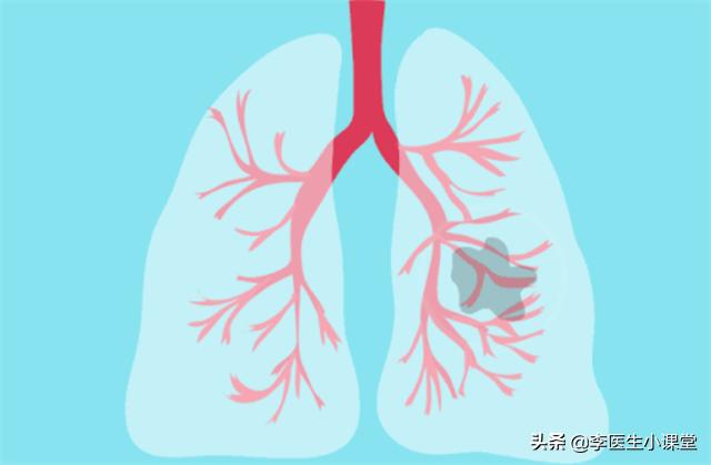 肺结节吃什么中药能让结节消失,如何让肺结节变小甚至消失