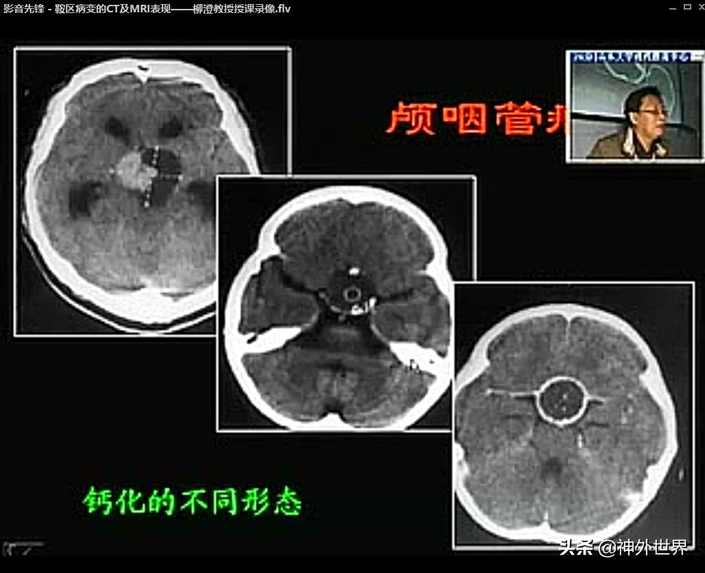 鞍区解剖学习笔记之——垂体