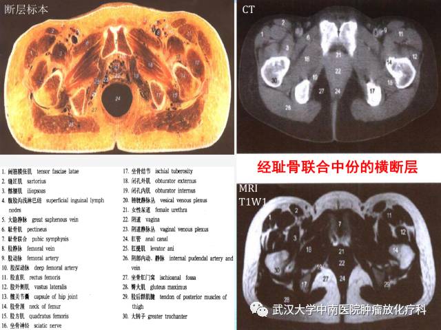 女性盆腔解剖与断层影像