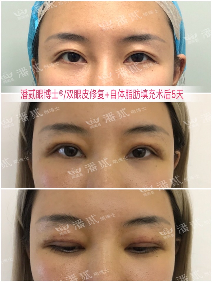 割双眼皮眼皮压下来会恢复吗,割双眼皮以后会松弛更快吗