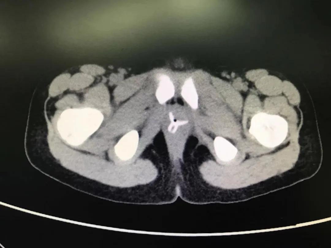 四岁孩子耳朵里塞进钢珠,小男孩往泥巴里塞6个钢珠