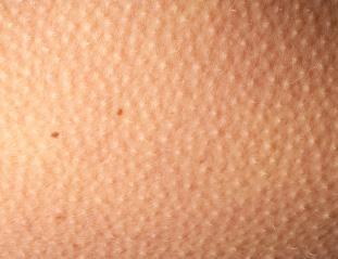 夏天出汗眼睛周围起疙瘩怎么回事,脸上眼睛周围有小米粒那样的疙瘩