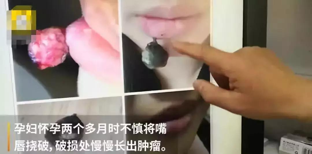 怀孕嘴巴里长血管瘤的女人,怀孕后嘴唇上长血管瘤