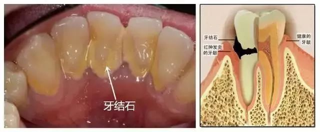 牙齿变黑变黄用什么清洗,牙齿发黄有牙垢用什么牙膏