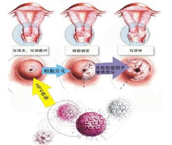妇科医生：宫颈囊肿的症状有哪些？女性宫颈囊肿的危害有哪些？