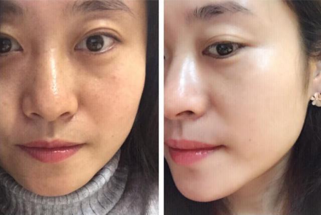 微整形美白针,微整形是永久的吗