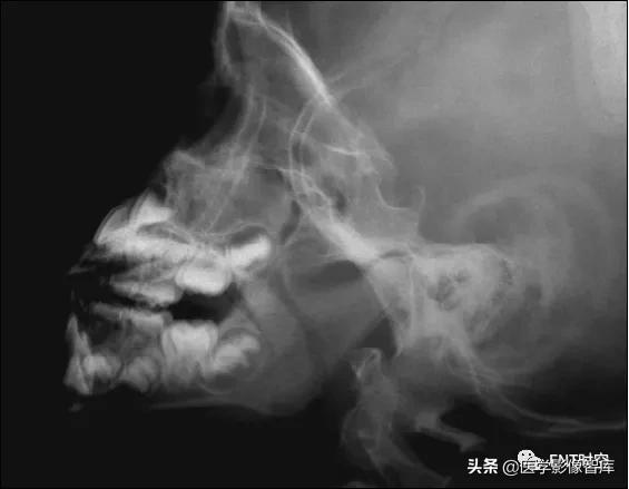 腺样体肥大有必要做x射线复查吗,最简单检测腺样体肥大的方法