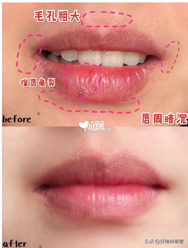 不花一分钱怎样快速祛痘,不花一分钱轻松祛斑