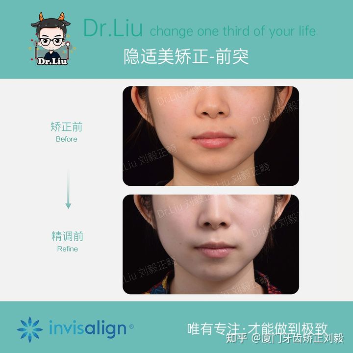 牙齿矫正厦门口腔医院,厦门隐形龅牙矫正优惠