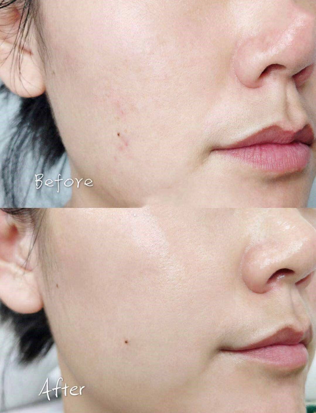 去闭口快速有效的方法,去闭口最有效的方法推荐