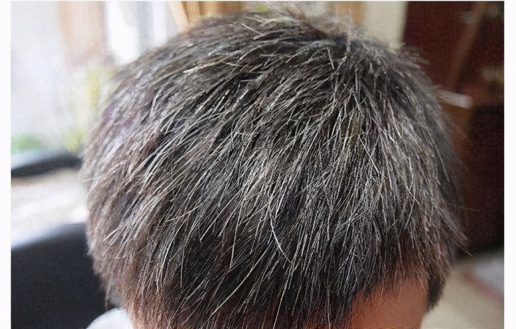 白头发长期吃什么头发可以变黑,头顶白发吃什么可以改善白头发