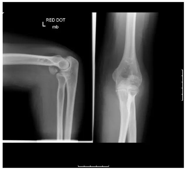 特殊骨折类型,特殊骨折体征
