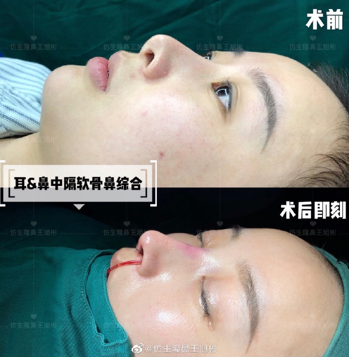 假体隆鼻耳软骨垫鼻尖图片,l型假体耳软骨隆鼻图片