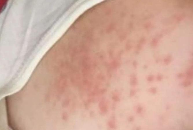 宝宝更换奶粉过敏怎么办,宝宝换奶粉出现过敏怎么办