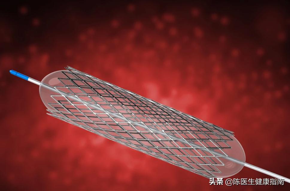 心脏支架是怎么把血管撑开的,心脏支架手术血管撕裂怎么办