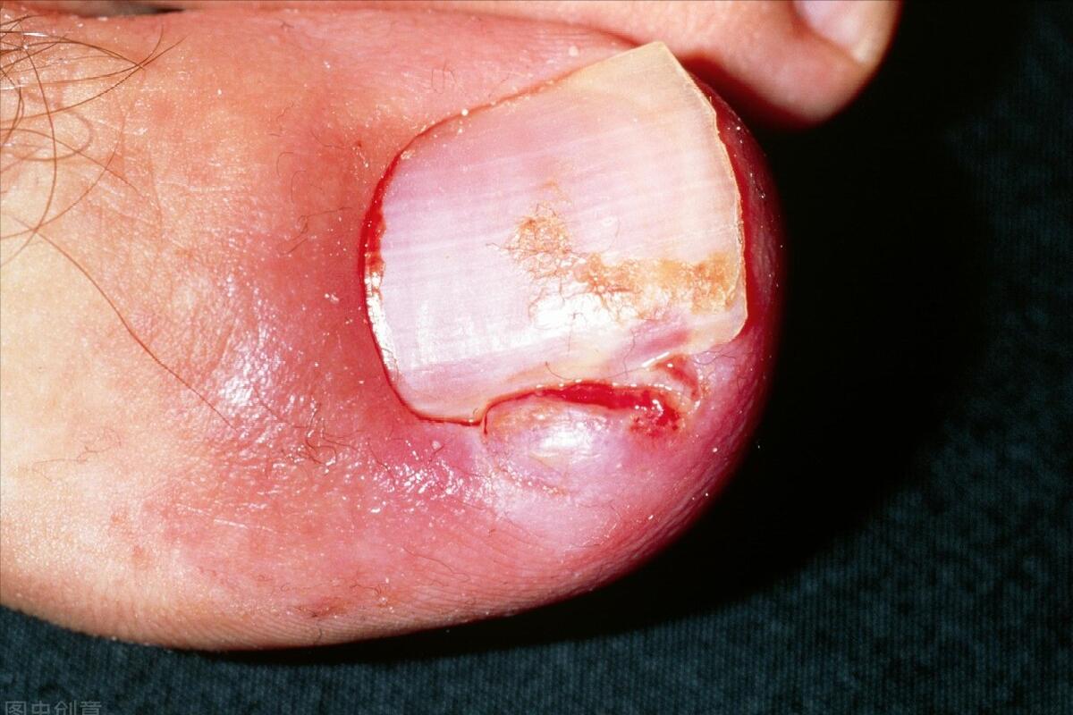 为什么会患上甲沟炎？孕妇患甲沟炎怎么办？