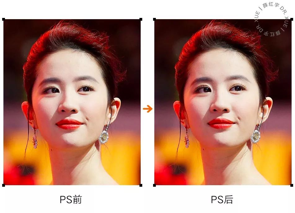 无痕双眼皮大概要多少钱,无痕双眼皮闭眼有痕