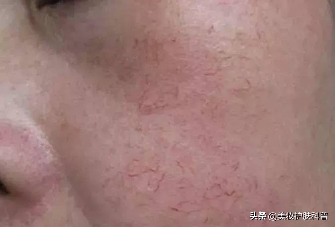 皮肤有血丝有点红怎么修复,红血丝养肤