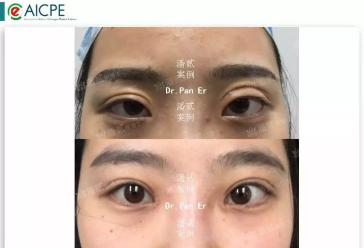 欧式大双眼皮和平行双眼皮,醒醒吧明智的放弃胜过盲目的执着