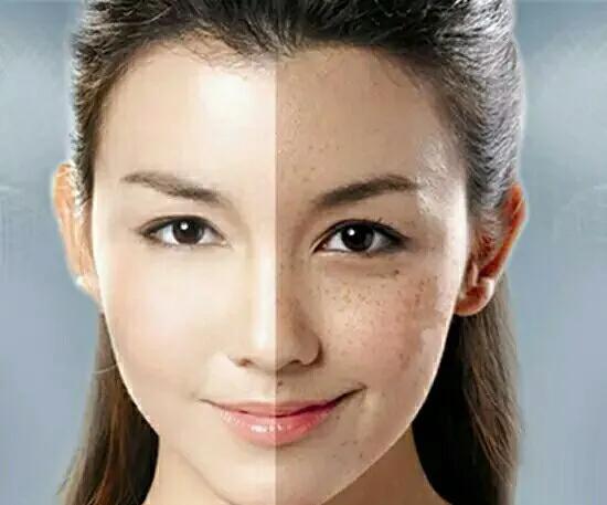 *褐斑黄**、雀斑、黑斑的诊治经验及用方用药一