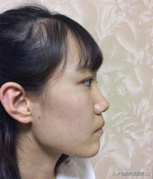 如何减掉顽固的脸颊肉？为什么减肥身上瘦了，脸还是又宽又胖？