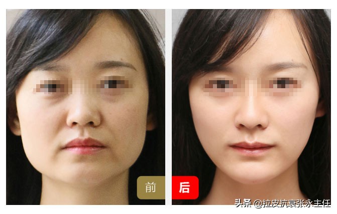 眼睑下垂什么原因造成的,眼皮松弛下垂是什么原因造成的