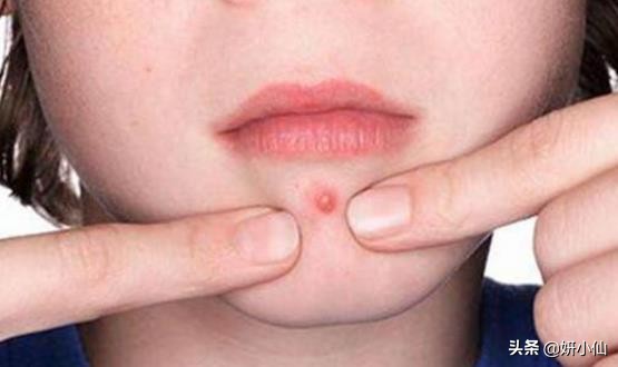 下巴长闭合性粉刺去除的方法,下巴白头粉刺是什么原因引起的
