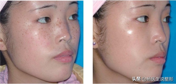 遗传性雀斑几岁可以激光祛斑,激光祛斑能不能根治雀斑