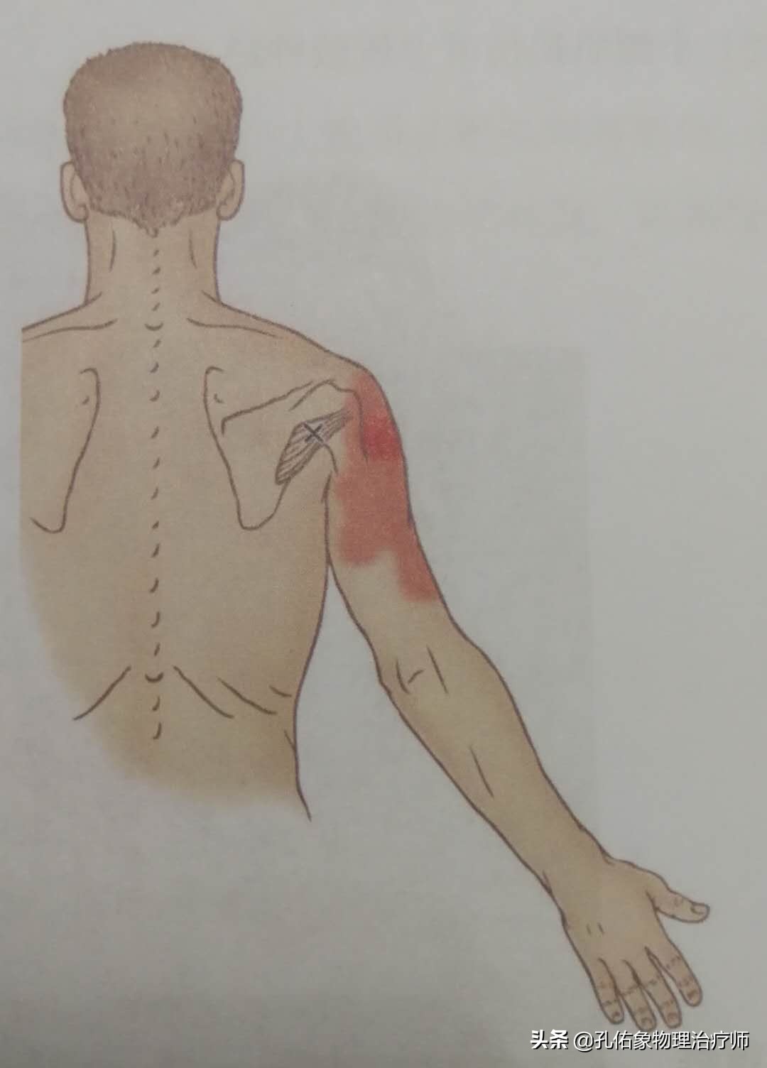 手指麻木是三大疾病前兆,手指麻木疼痛怎么治疗最好