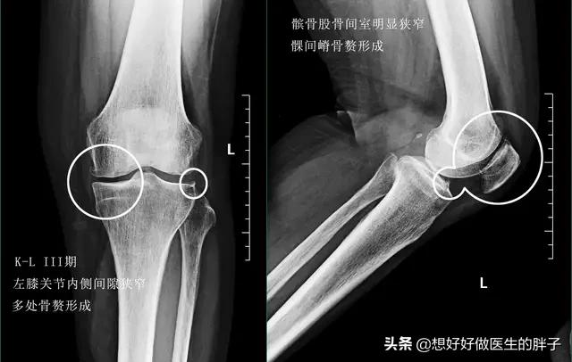 膝关节骨刺正确治疗方法,膝关节骨刺怎么缓解症状