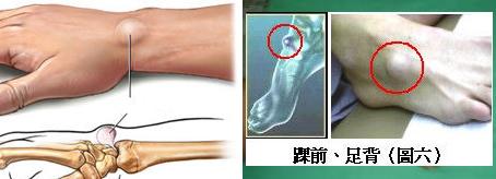 腕部腱鞘囊肿怎么治疗,奶奶抱孩子累得腱鞘炎怎么办