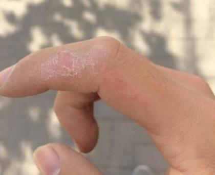 502胶水粘住手怎么才能弄掉,502粘住手了怎么办