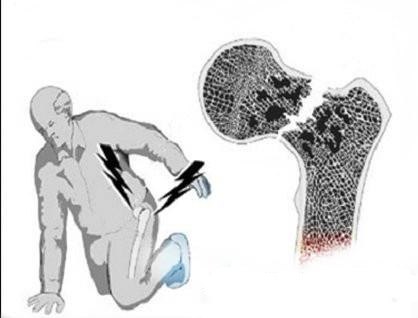 骨折引起肺栓塞好治吗,80岁老人肺栓塞怎么治